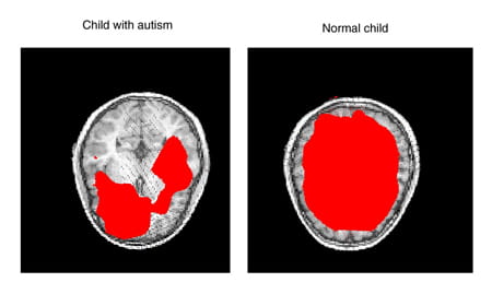 Magnetic source imaging (MSI) showing the neuromagnetic distribution of endogenous activities in a child with ASD and a typically developing child.